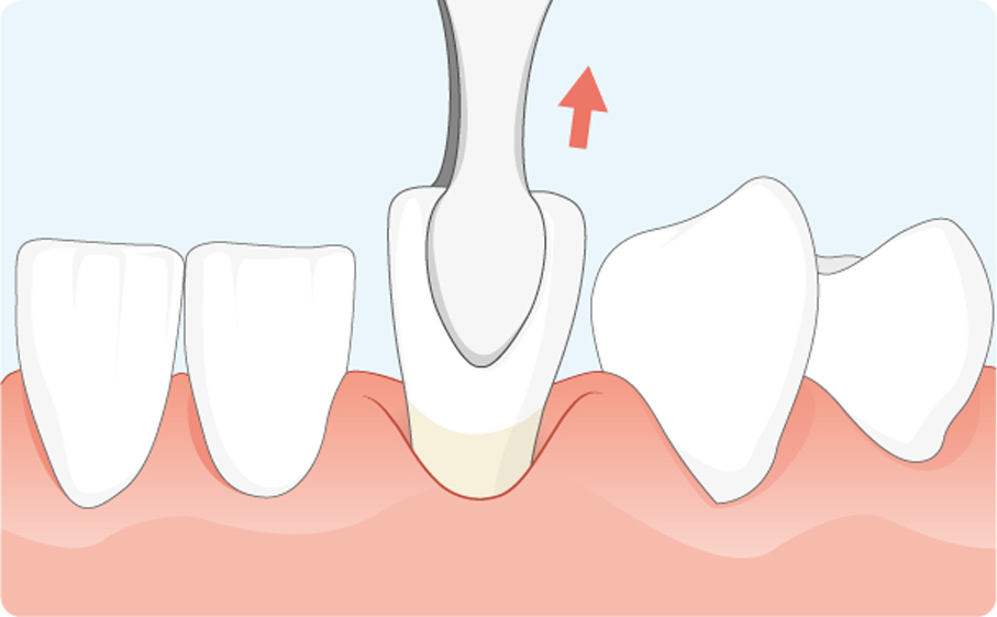 Extraccion dental