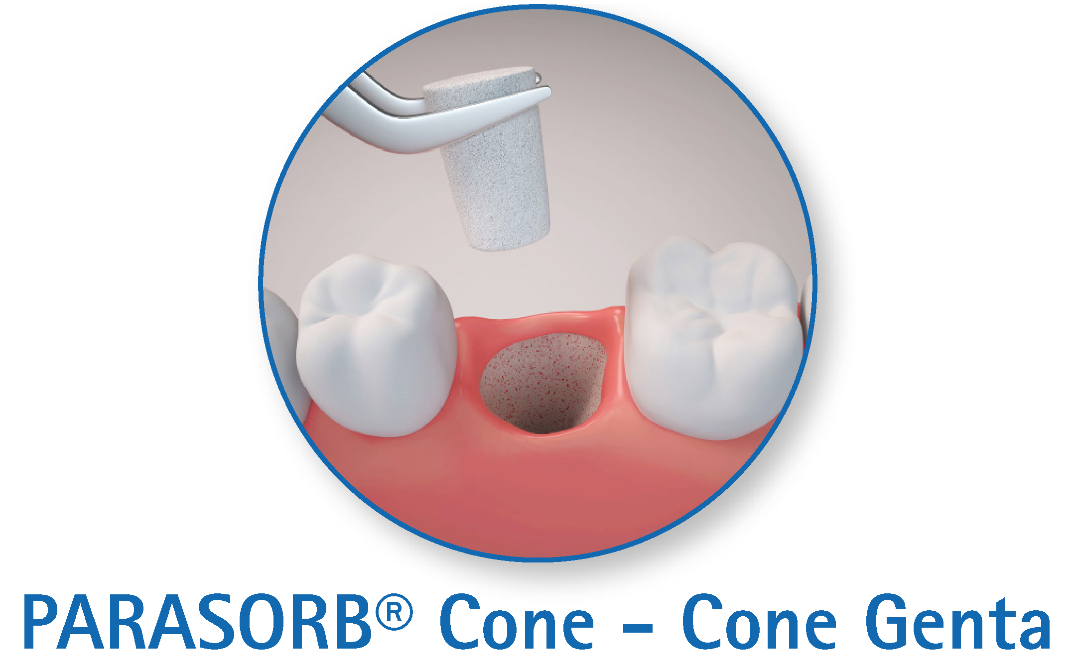 Parasorb Cone